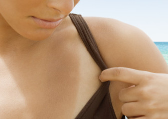 Un soin réparateur coups de soleil fait maison